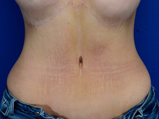 Reverse Abdominoplasty Before & After